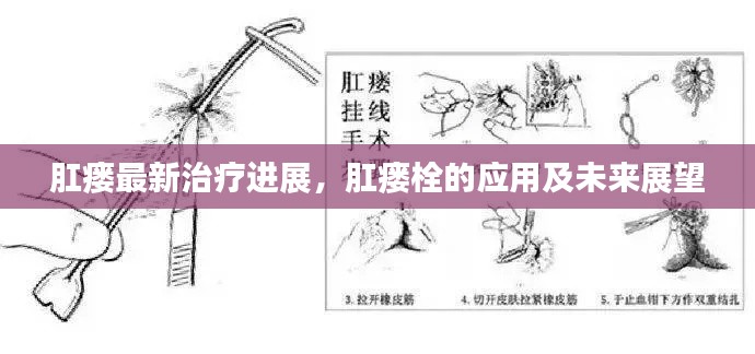 肛瘘最新治疗进展,肛瘘栓的应用及未来展望