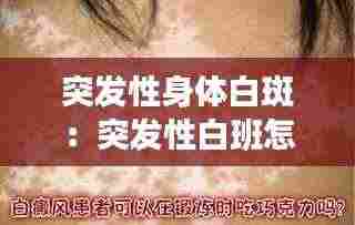 突发性身体白斑：突发性白班怎么治疗 